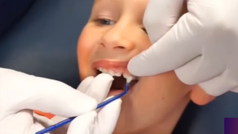 penyebab gigi berlubang pada anak 2