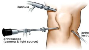 Apa itu artroskopi? memahami prosedur, manfaat dan 11 risiko