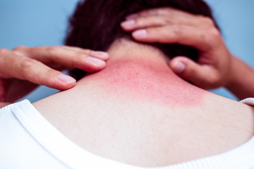 Apa itu sunburn? Gejala Diagnosis dan pengobatan serta 6 resiko