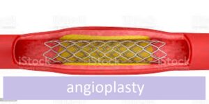 angioplasty