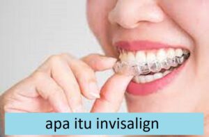 apa itu invisalign