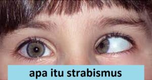 apa itu strabismus