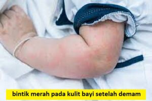 bintik merah pada kulit bayi setelah demam
