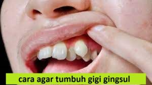 cara agar tumbuh gigi gingsul