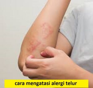 cara mengatasi alergi telur