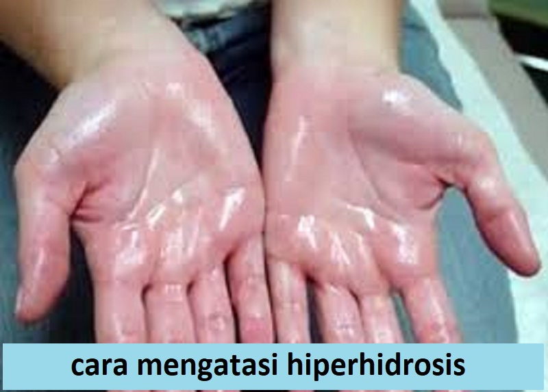 cara mengatasi hiperhidrosis