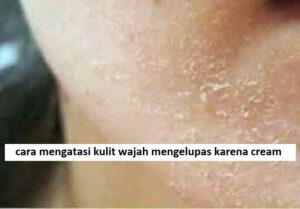 cara mengatasi kulit wajah mengelupas karena cream