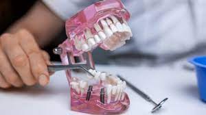 cara merawat gigi palsu permanen