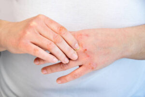 dishidrotik dermatitis